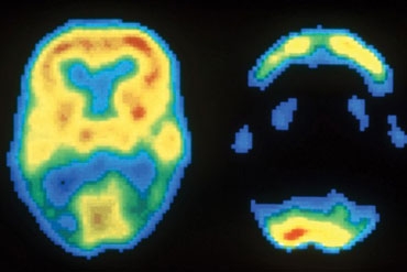 WUMed | Alzheimer a sztuczna inteligencja